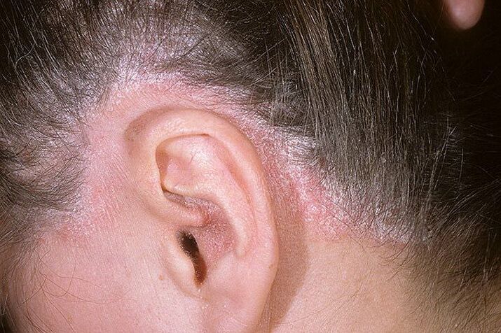 Psoriasis kitörések a fejen a fülek mögött