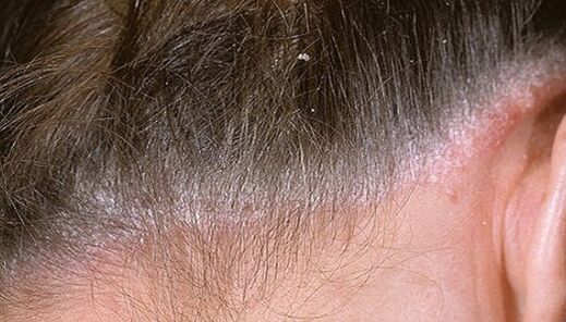 Psoriasis a fején