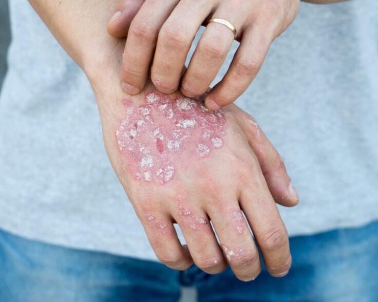 Psoriasis a kezekben