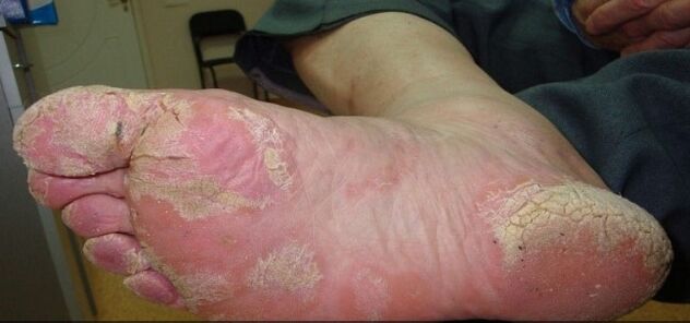 Psoriasis a lábakon