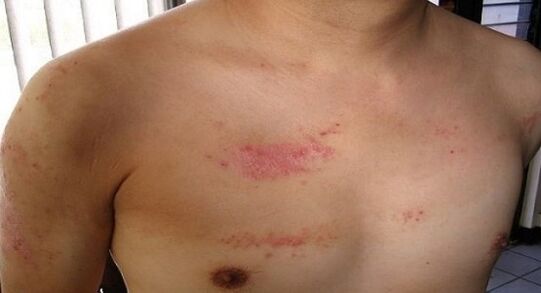 Psoriasis a mellkas területén