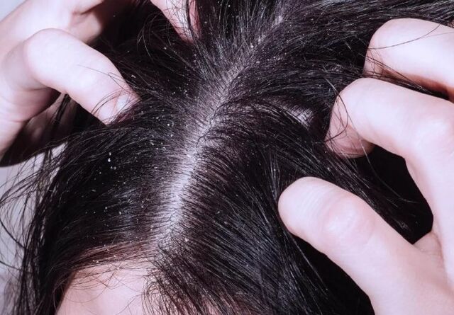 Psoriasis a fején