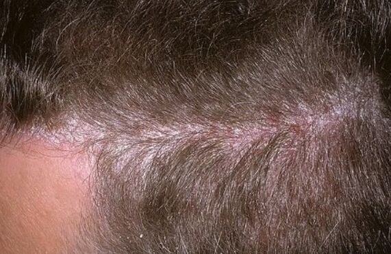 Psoriasis a fején