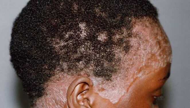 Psoriasis a fején