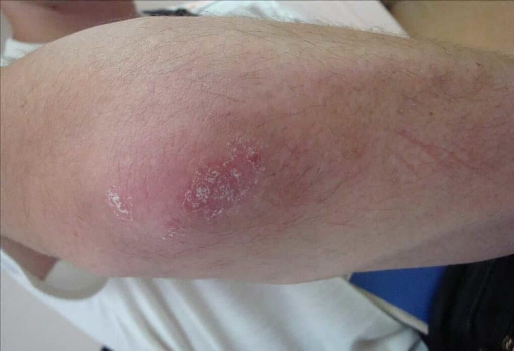Hogy néz ki a psoriasis