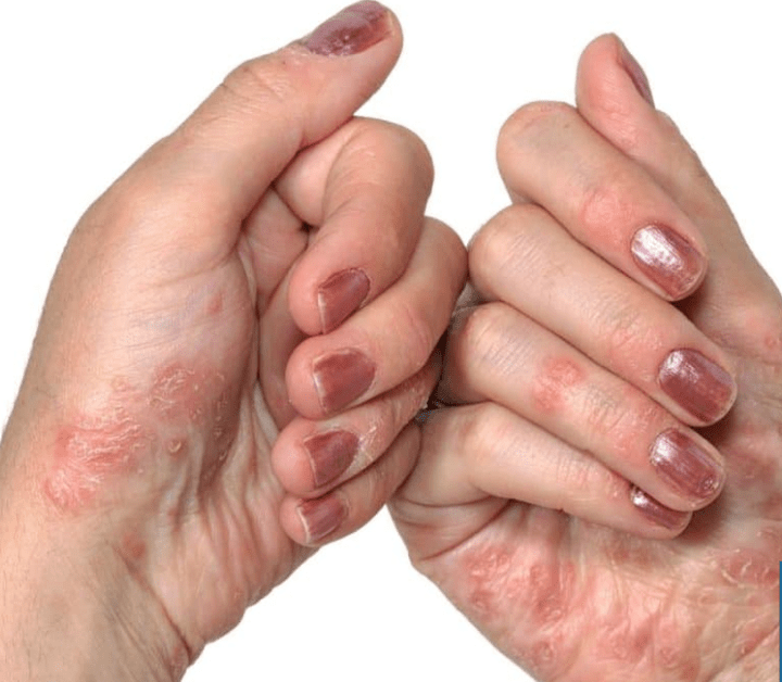 Psoriasis a kezekben