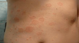 Szerencsétlen psoriasis