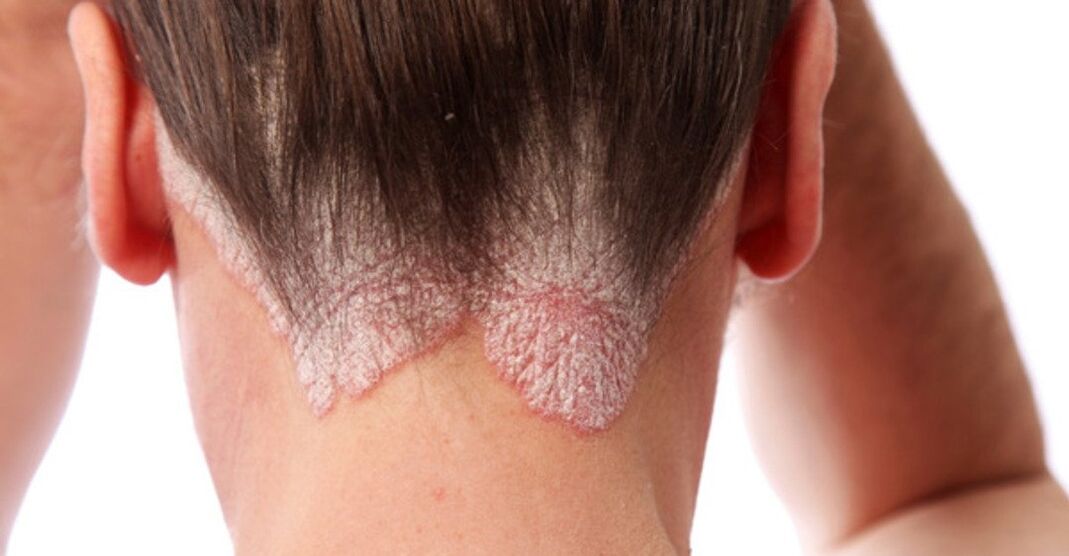 Psoriasis a lányok fején