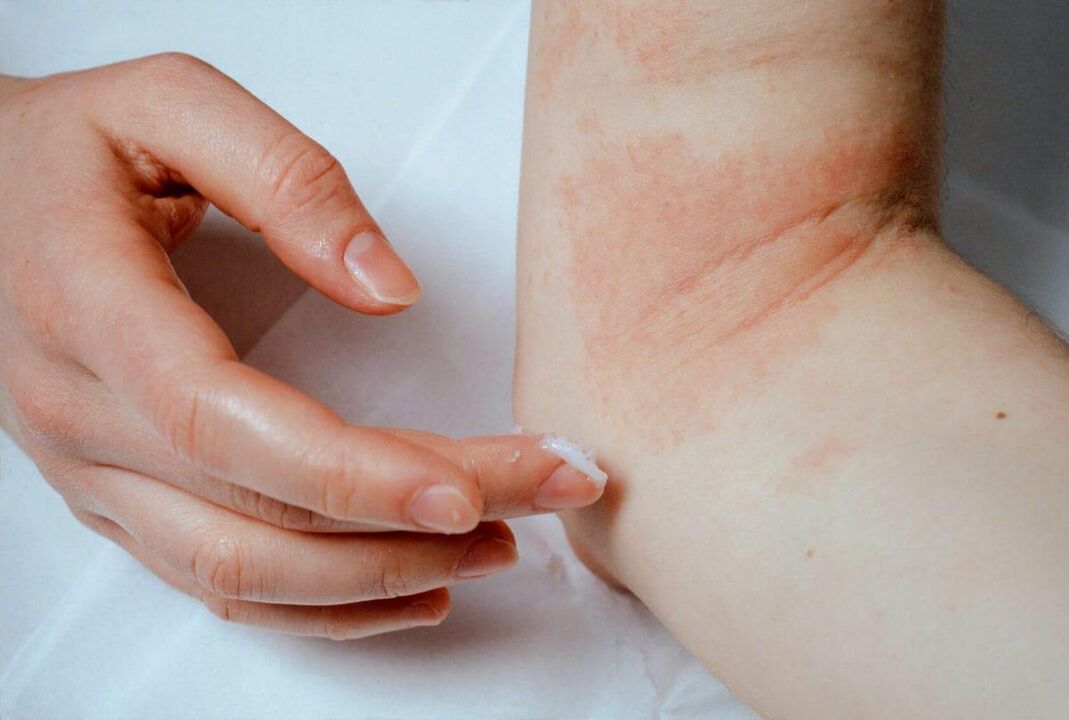 A psoriasis kezelése