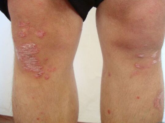 A psoriasis okai