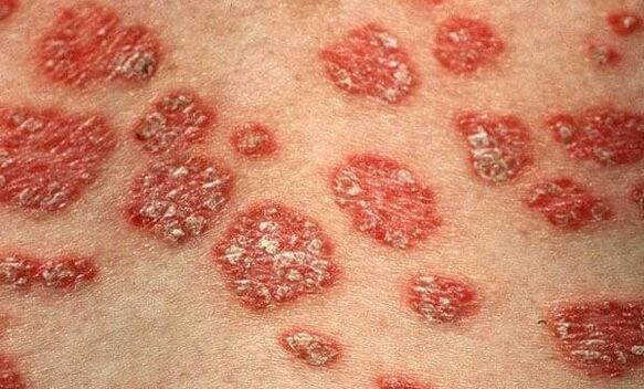A psoriasis formái