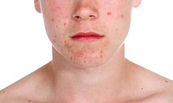 A psoriasis tünetei