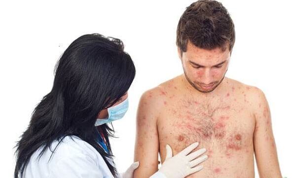 Psoriasis fotó