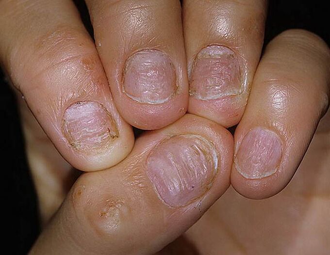 A körmök psoriasis