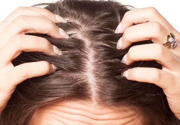 Psoriasis a fején