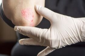 Psoriasis a könyökön