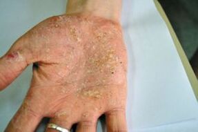 Psoriasis a tenyerében