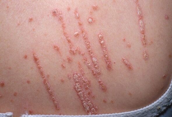 Psoriasis a testen