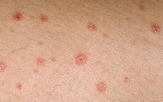 Psoriasis a kezdeti szakaszban