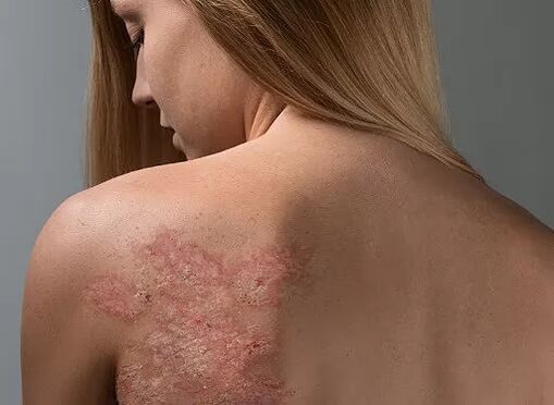 Psoriasis egy lány hátán