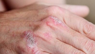 a psoriasis kezdeti szakaszának tünetei