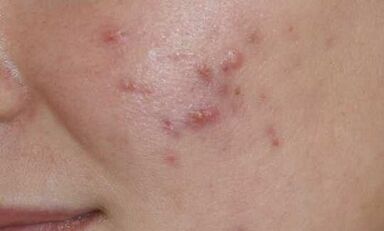 a psoriasis kezdeti szakaszának tünetei