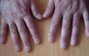 a psoriasis tünetei a kezdeti szakaszban