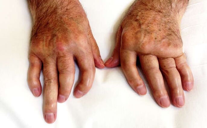 Valódi kezelések a pikkelysömörhöz - Pikkelysömör (psoriasis) tünetei, kezelése - Dermatica