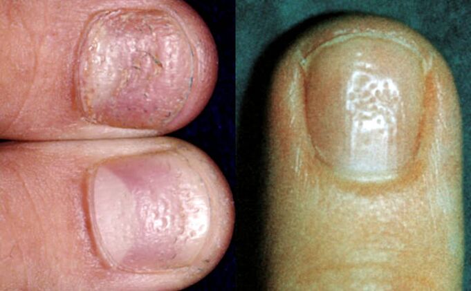 kézi nail gombák tünetek