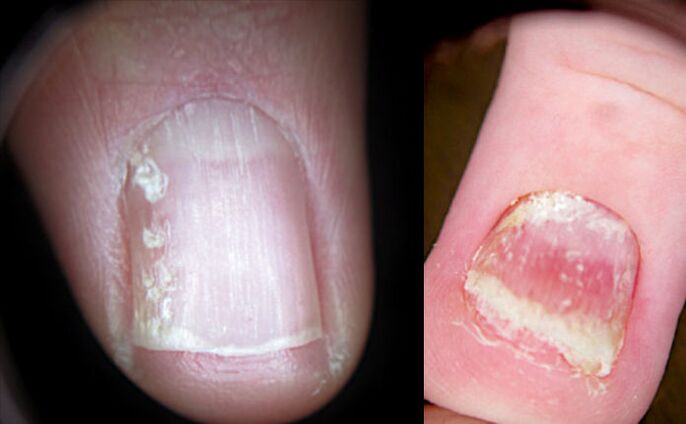 Hogyan lehet kezelni a gombás fertőzést a lábán ⋆ Körömgomba kezelése