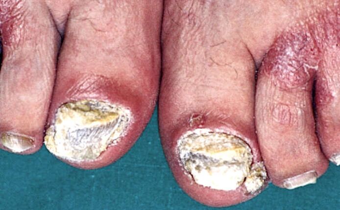 Súlyos subungualis hyperkeratosis és pikkelysömör plakk a lábujjakon