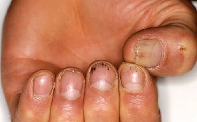 fungus az ujjakon a köröm alatt hírek kenőcs körömgombától