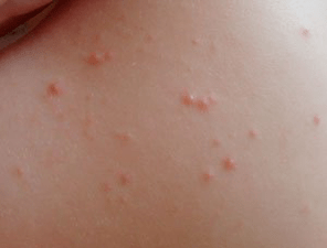 bőrbetegségek ekcéma pikkelysömör kezelése száraz bőr lelki okai kinai medicina