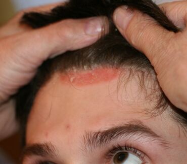 scalp psoriasis natural treatment coconut oil