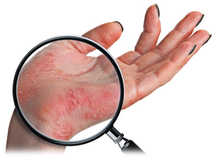 eczema numular mit kell tenni ha vörös száraz foltok vannak az arcon